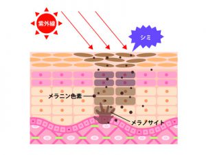 シミの発生要因