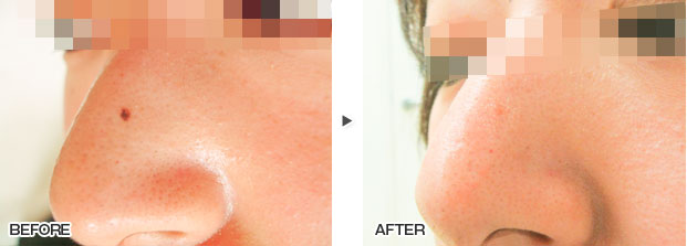 鼻の上のほくろ除去の症例