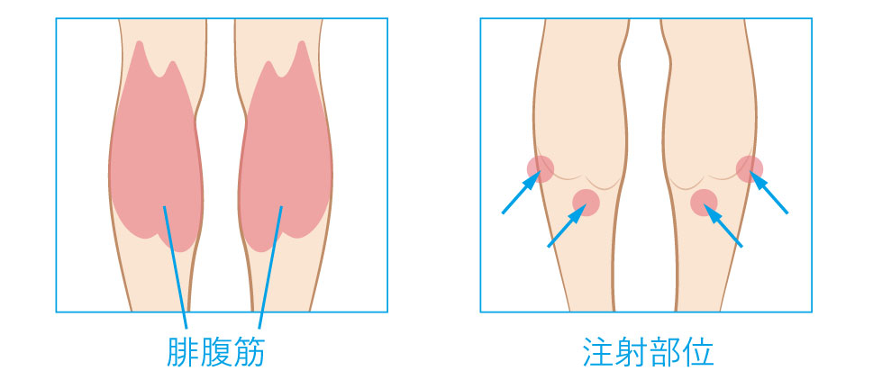 ふくらはぎボトックス