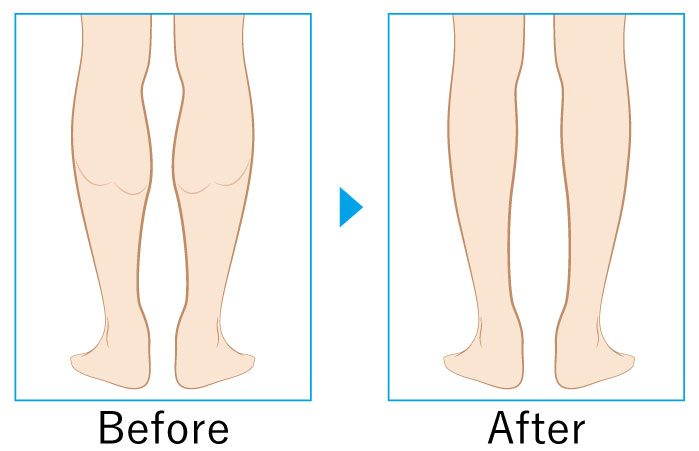 ふくらはぎボトックス注射の痩身治療 ソノクリニック 大阪 神戸 美容皮膚科 美容外科
