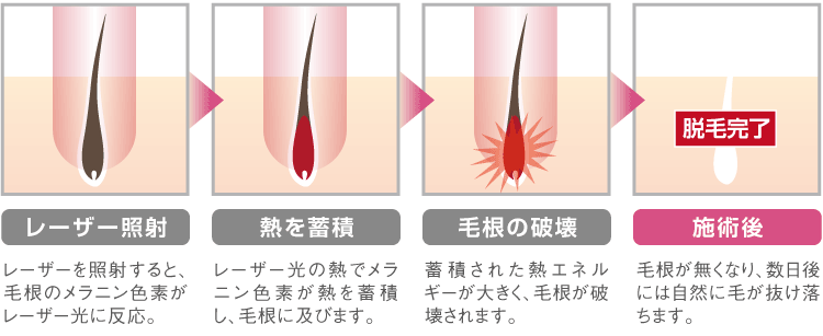 医療レーザー脱毛（ジェントルレーズ脱毛）