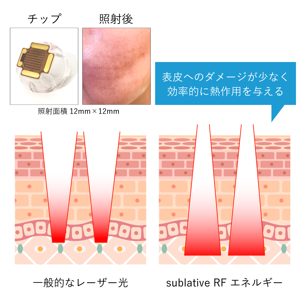 フラクショナルRF