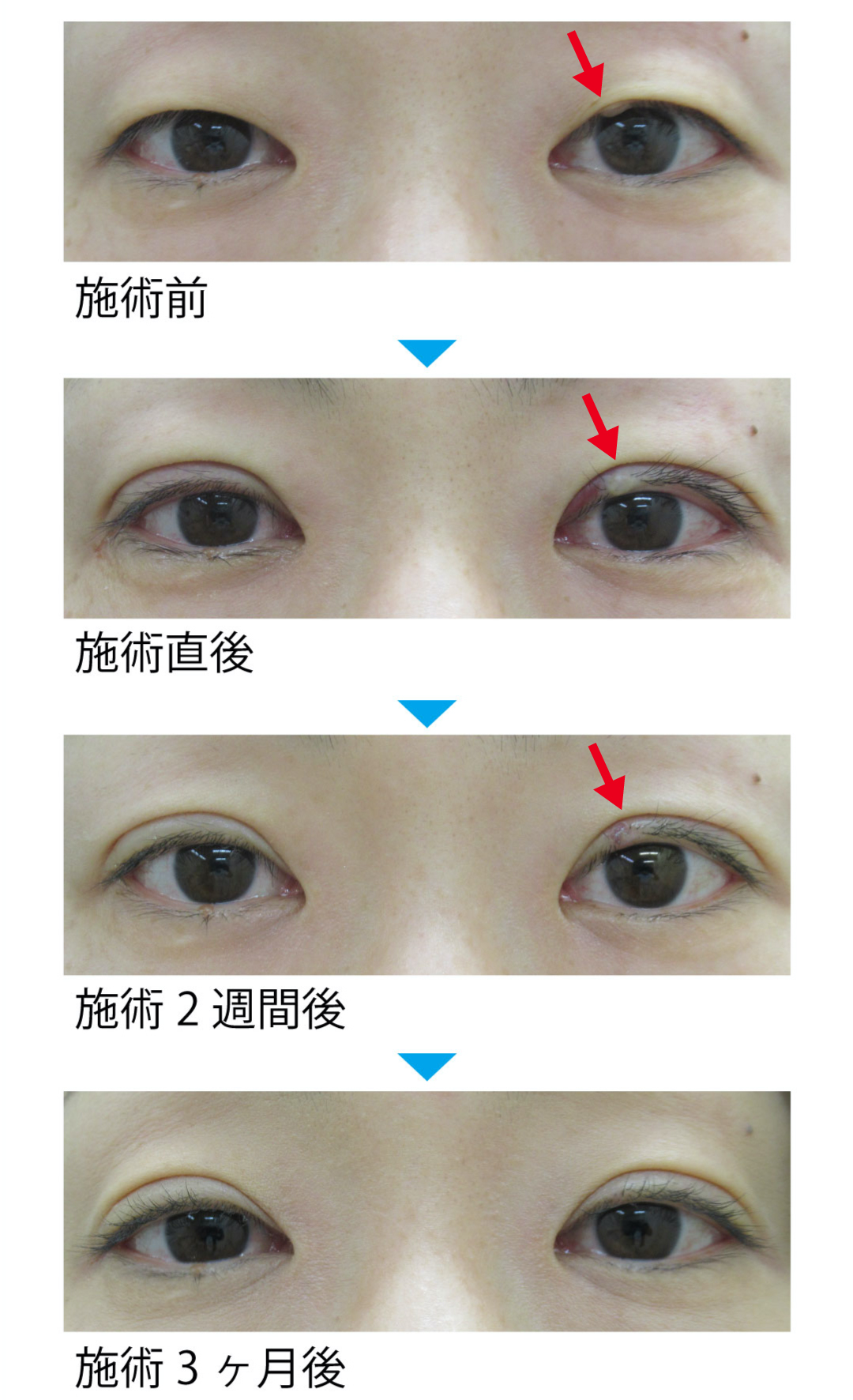 目 の 腫れ を 直す 方法