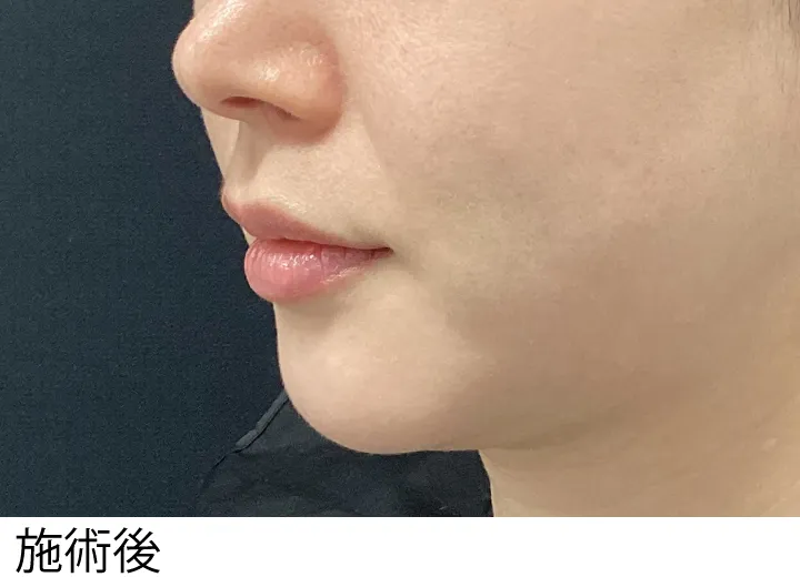 症例13施術後