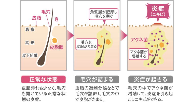 ニキビが出来る仕組み