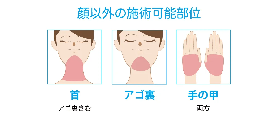 フォトRF照射可能部位