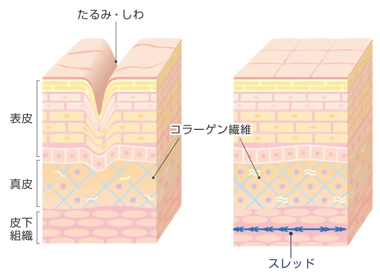 小顔美肌リフトの作用イメージ