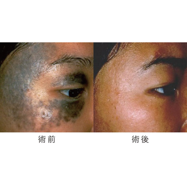 アザ治療の症例写真