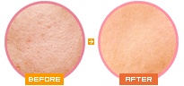 フォトRFハリキメの治療