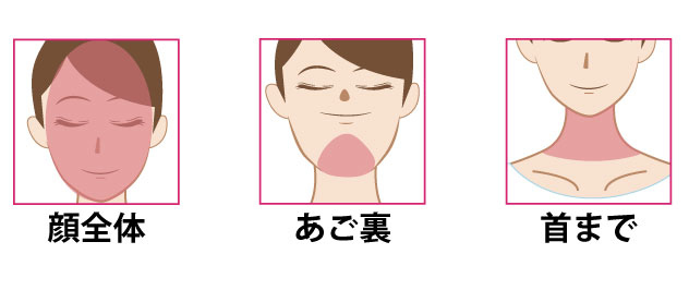 ケミカルピーリング施術の施術可能部位