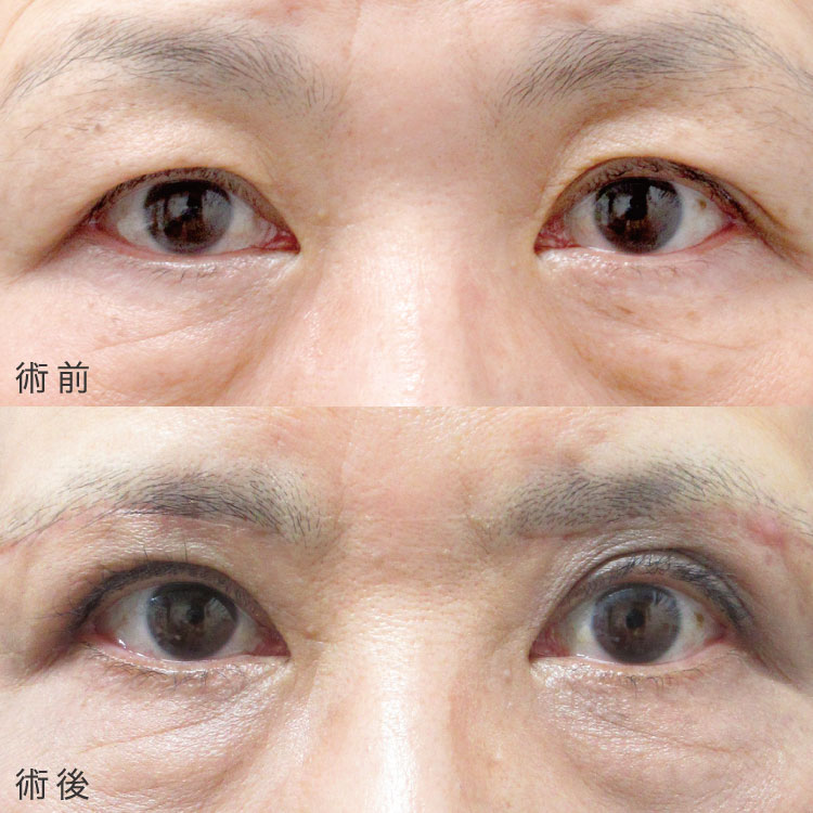 眉下リフト法の症例写真