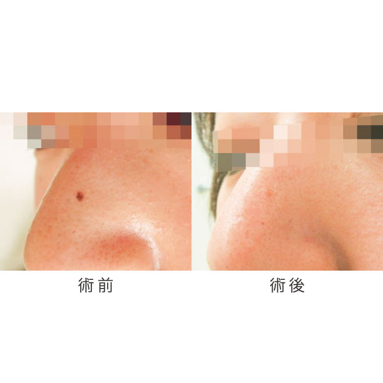 ほくろ除去の症例写真