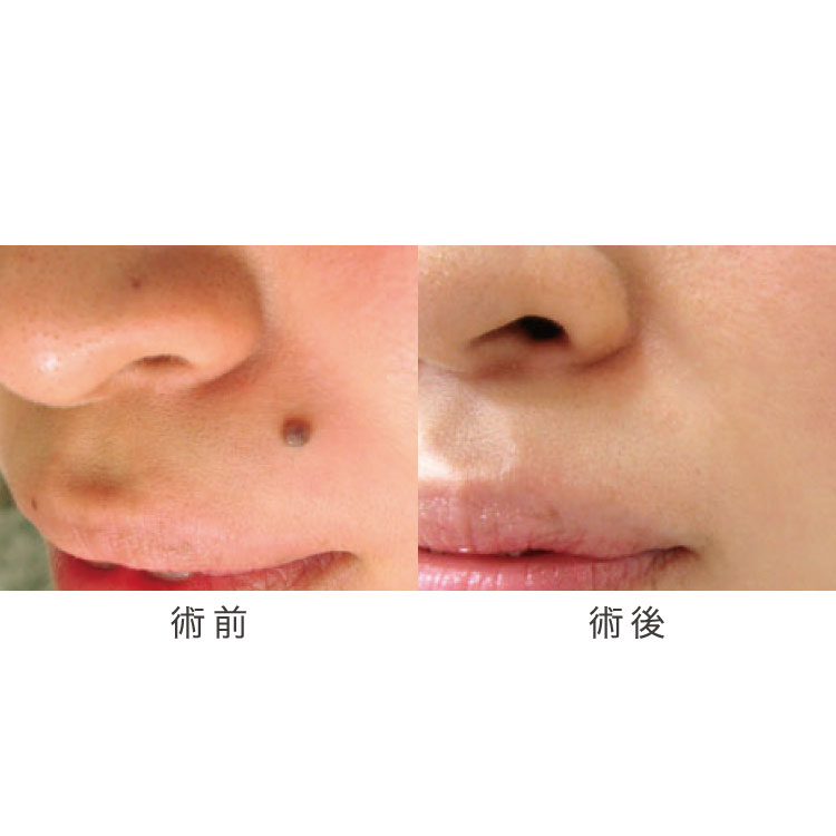 ほくろ除去の症例写真