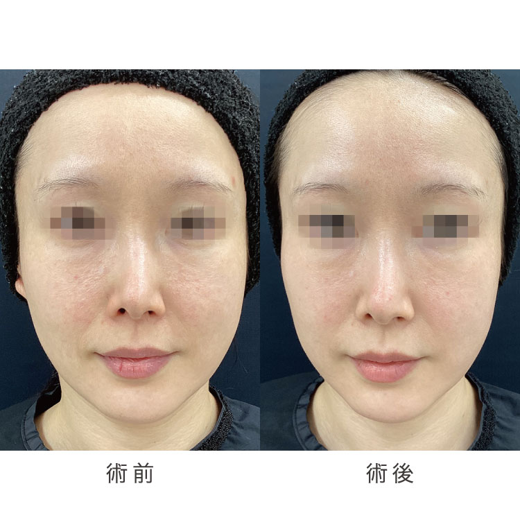 ハイコックス症例写真