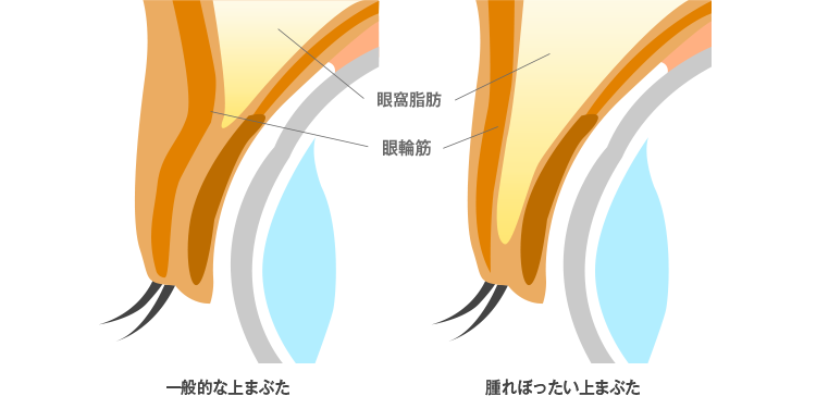腫れぼったいまぶたの構造
