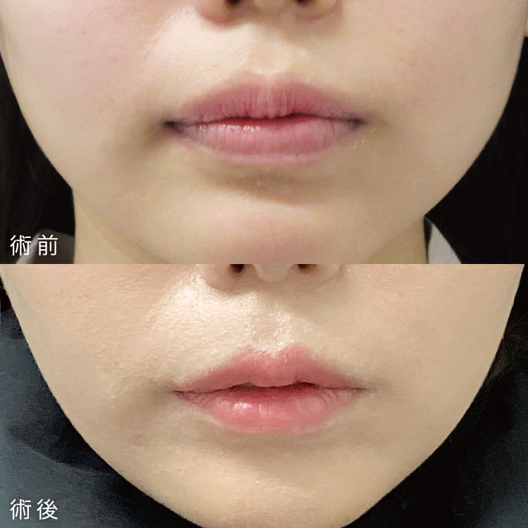 口唇縮小術の症例写真