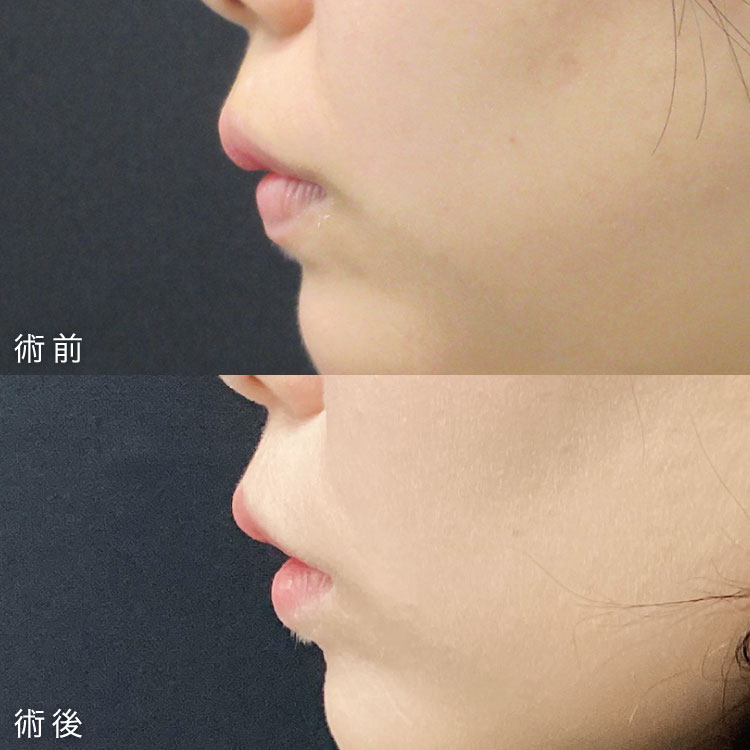 口唇縮小術症例写真