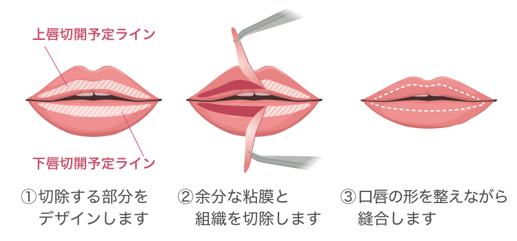 口唇縮小術のイメージ