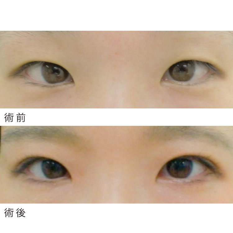 二重埋没法症例写真