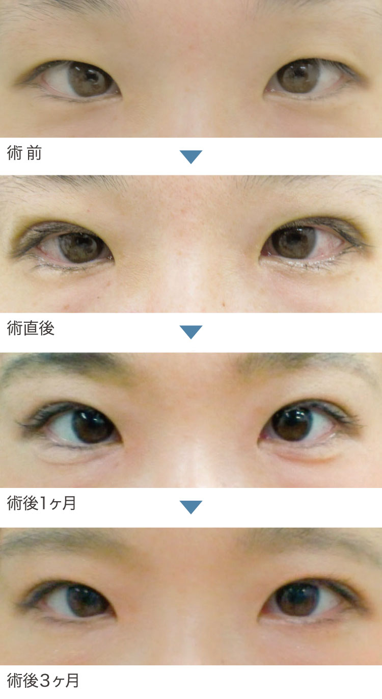 二重埋没法症例経過写真