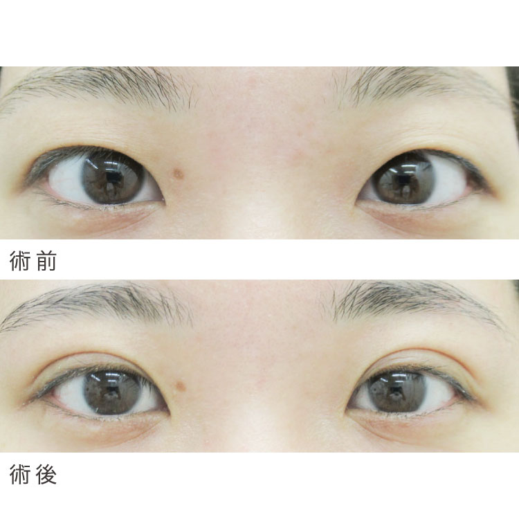 二重埋没法症例写真