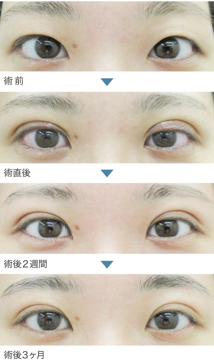 二重埋没法症例経過写真
