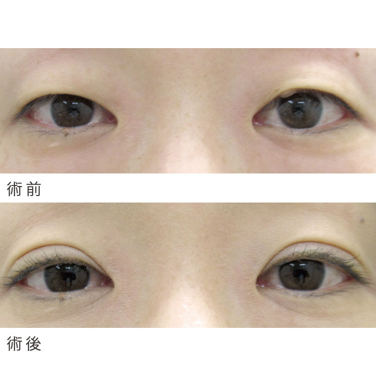 二重埋没法症例写真