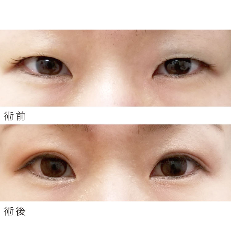 二重埋没法症例写真