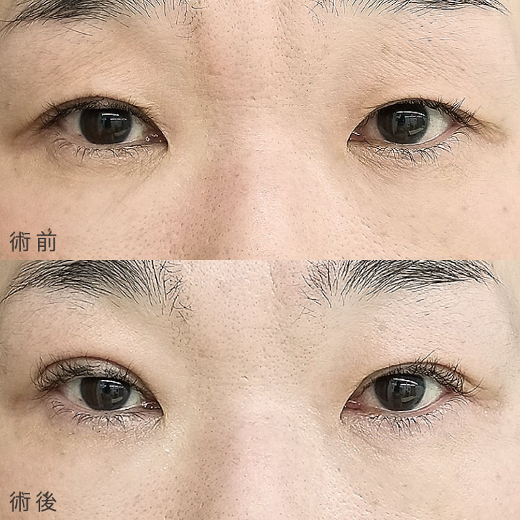 二重埋没法の症例写真