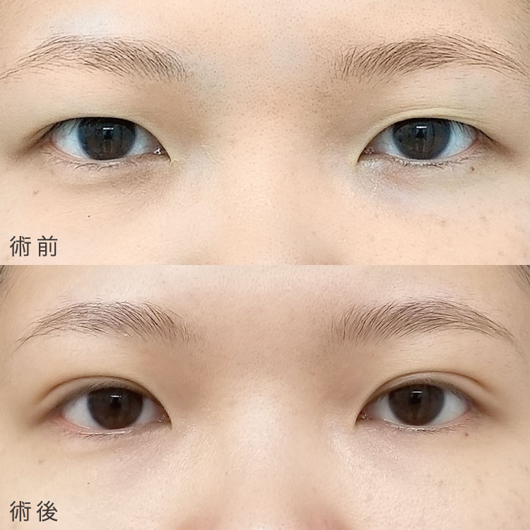 二重埋没法の症例写真