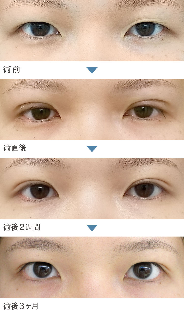 二重埋没法+まぶたの脂肪取り症例経過写真