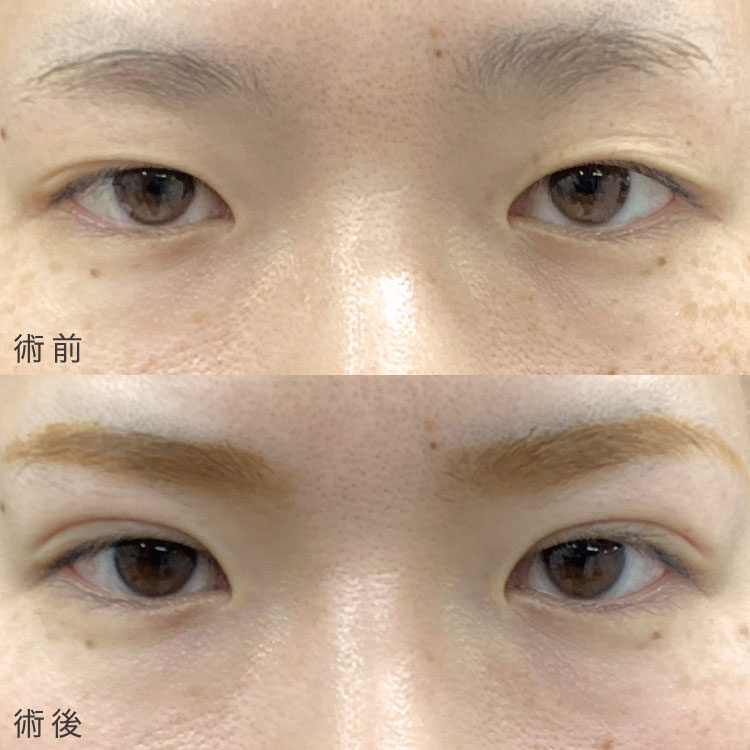 二重埋没法症例写真