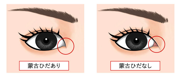 蒙古襞