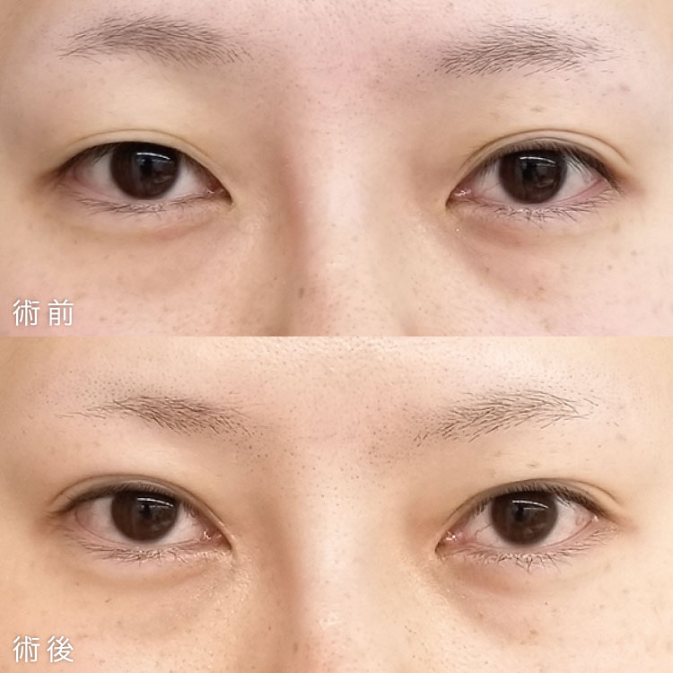 目頭切開法の症例写真