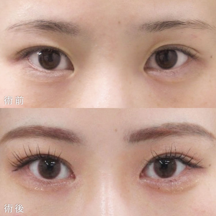 目頭切開法の症例写真
