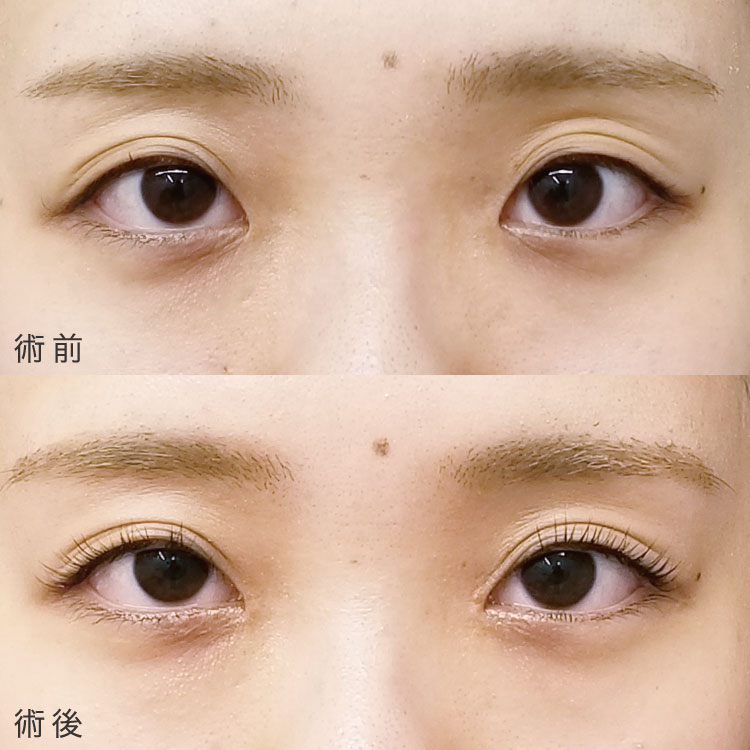 目頭切開法の症例写真