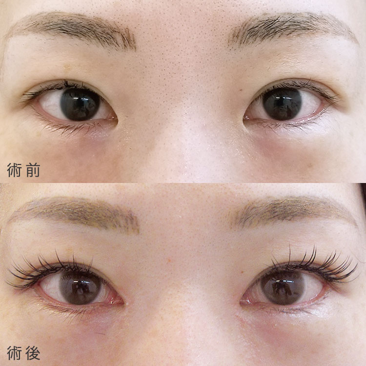 目頭切開法の症例写真