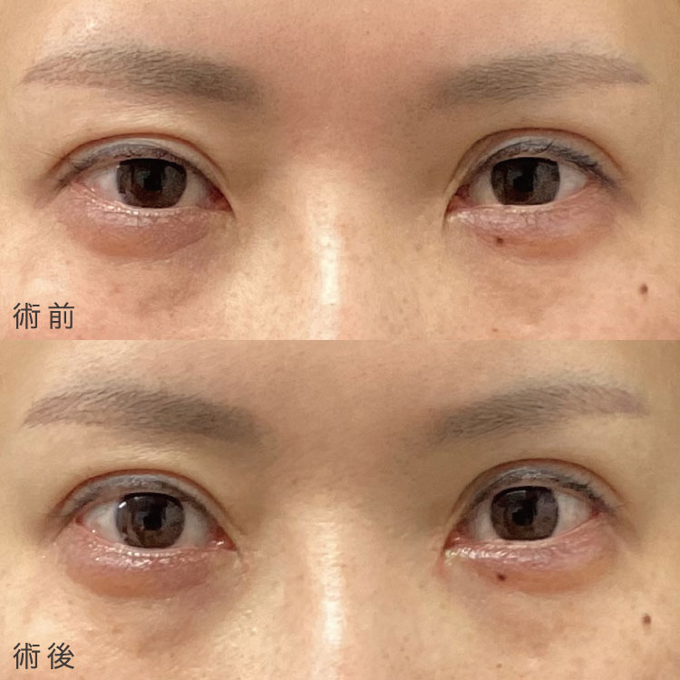 目頭切開法症例写真