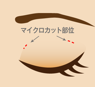 マイクロカット脂肪取り法