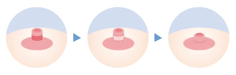 乳管温存術（Lewis法）のイメージ