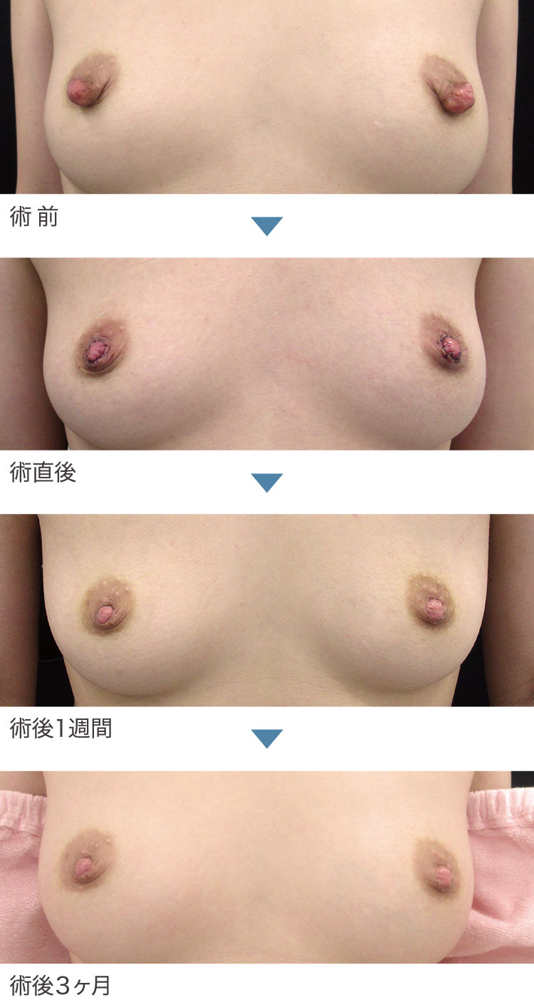 乳頭縮小術症例経過写真