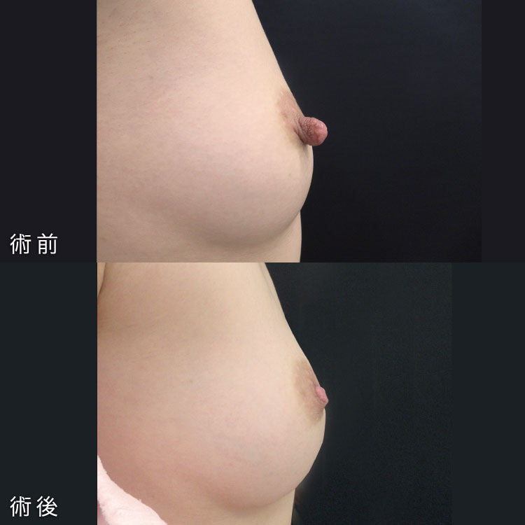 乳頭縮小術症例写真
