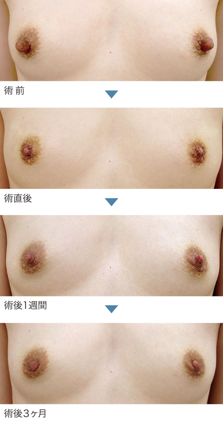 乳頭縮小術症例経過写真