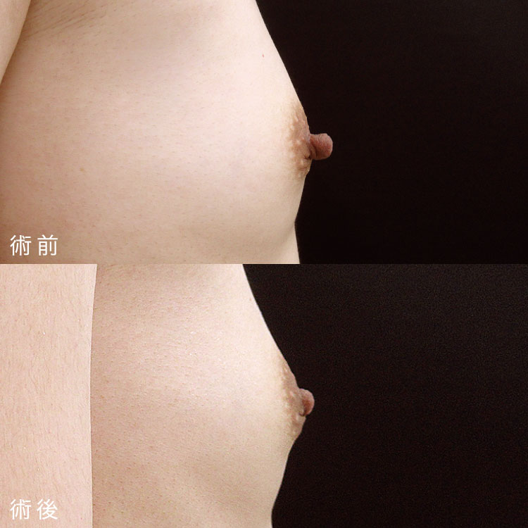 乳頭縮小術症例写真