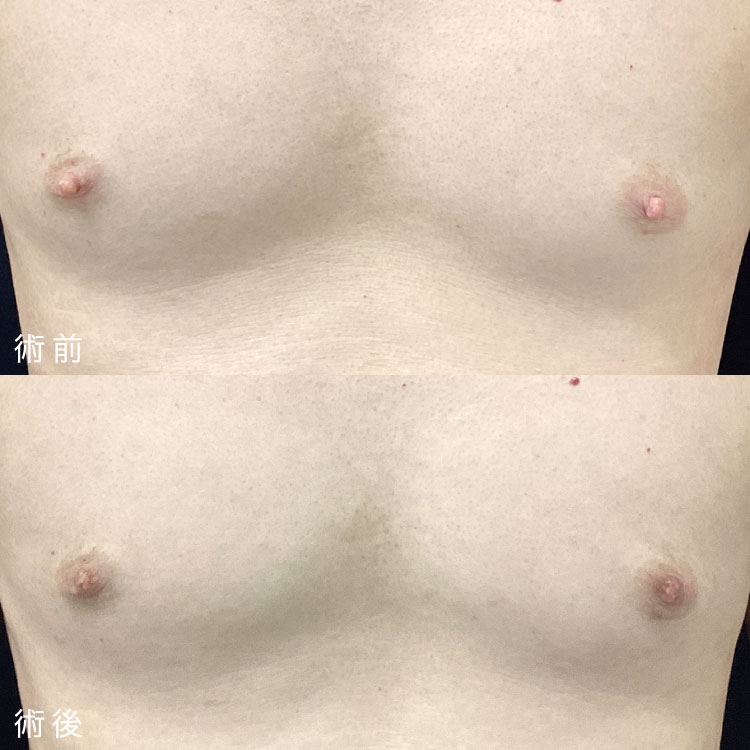 乳頭縮小術症例写真