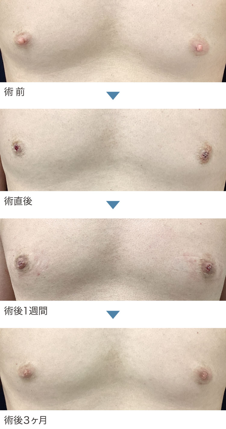 乳頭縮小術症例経過写真