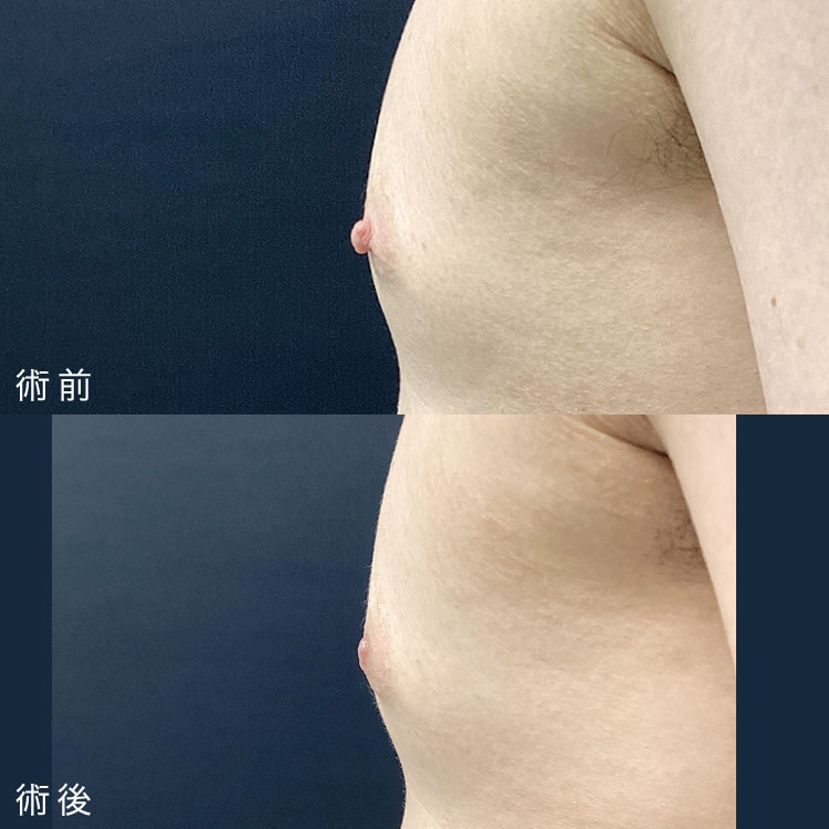 乳頭縮小術症例写真