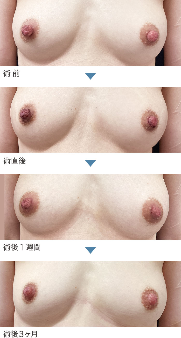 乳頭縮小術症例経過写真