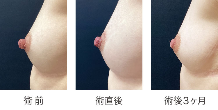 乳頭縮小術症例経過写真