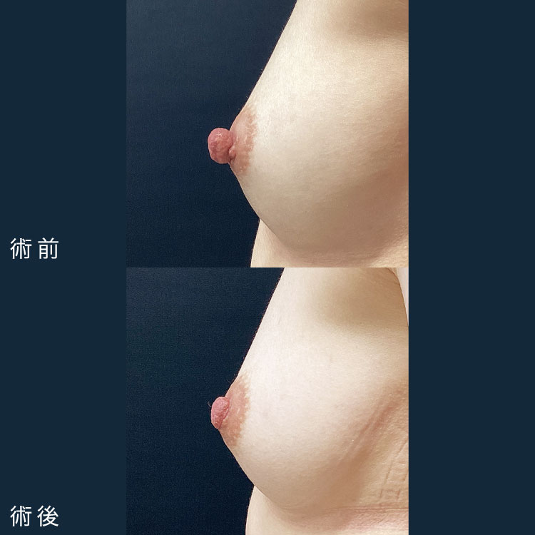 乳頭縮小術症例写真